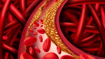 Kolesterol Yüksekliği (Hiperkolesterolemi) Nedir? Nasıl Tespit Edilir?